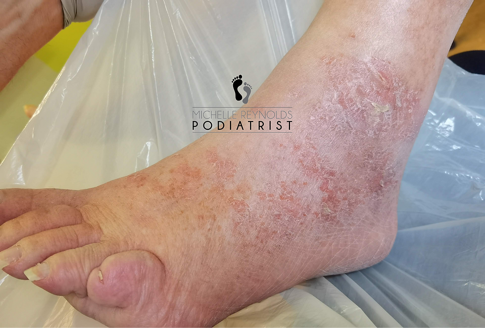 Dry, reddish foot with peeling skin. Text reads "Michelle Reynolds Podiatrist."