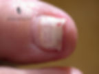 A nail which has a white discoloured surface due to damage from gel nail polish