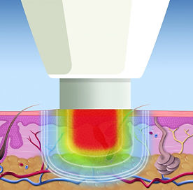 swift microwave treatment verruca