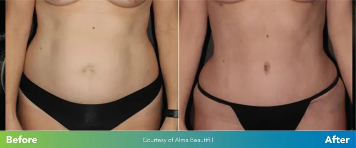 Before-Afters.laserlipo.2-05-scaled.jpg.webp