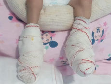 COREN VAI INVESTIGAR CONDUTA DE PROFISSIONAIS APÓS AQUECEDOR QUEIMAR PÉS DE BEBÊ EM JACAREÍ