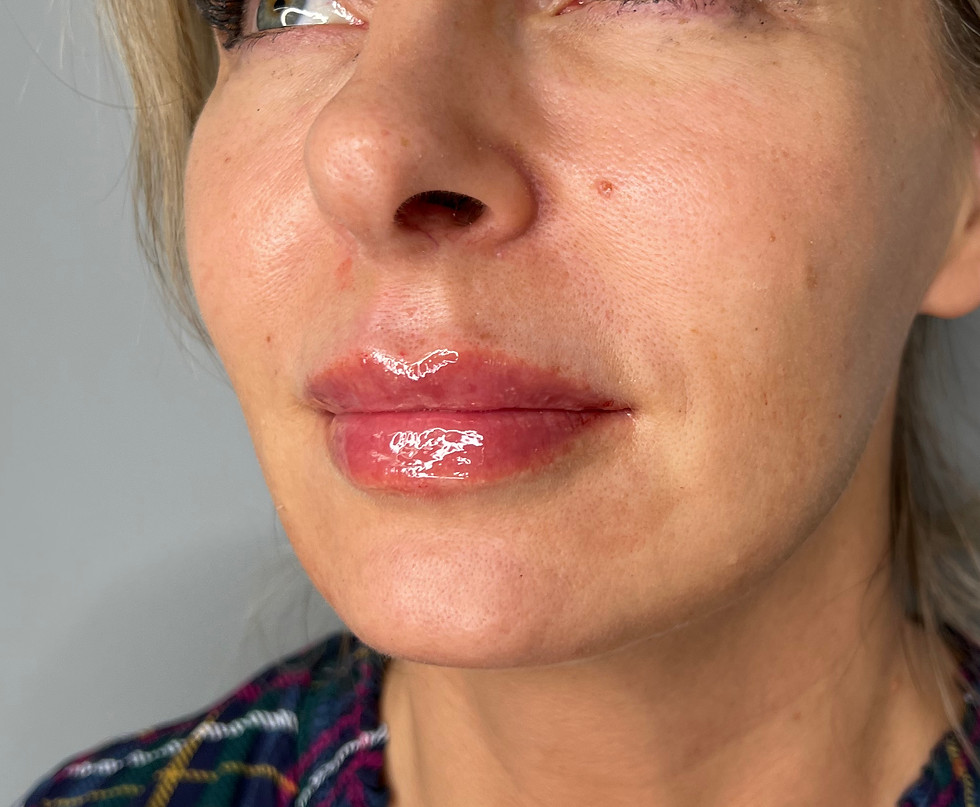 After image showing natural-looking lip filler treatment at odNOVA Aesthetics in Brighton, with subtle lip hydration, definition and shape improvement.
