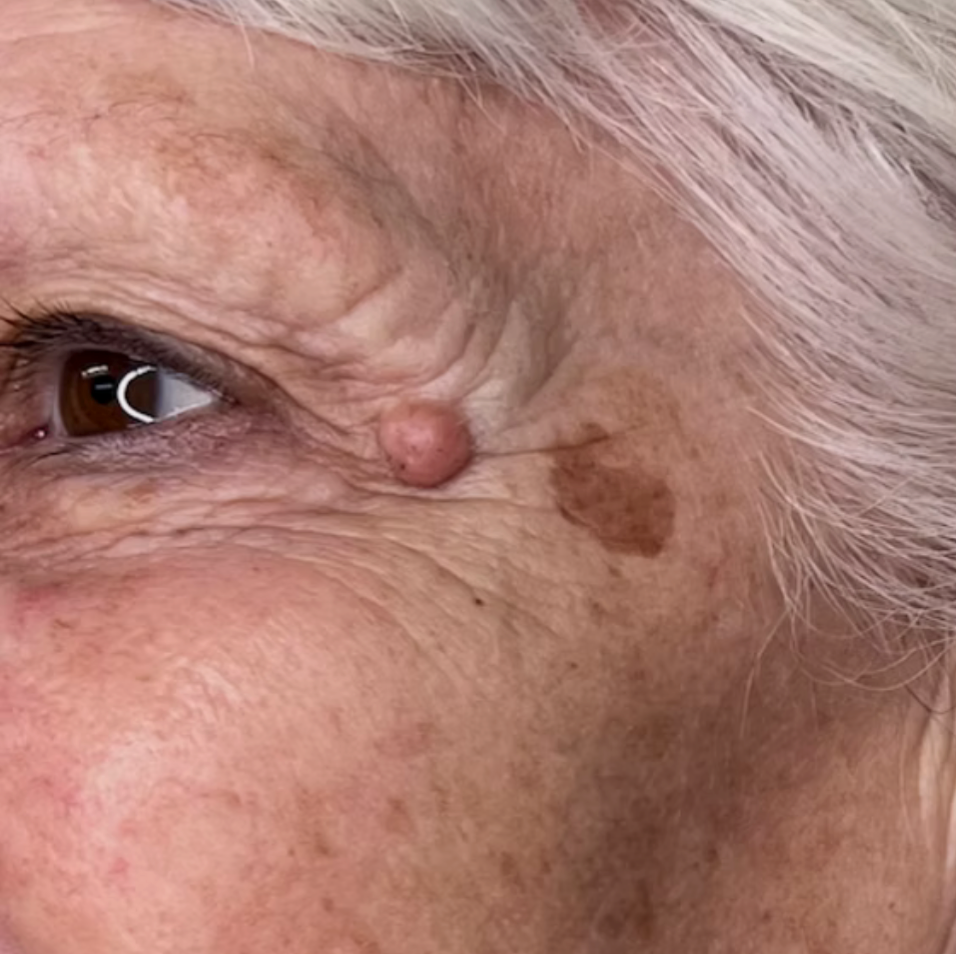 Detailed close-up of a prominent raised dermal mole and a flat solar lentigo (sun spot) in the periorbital area before clinical assessment and aesthetic removal at odNOVA Aesthetics in Brighton.