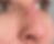 After image showing improved nasal contour following non-surgical rhinoplasty at odNOVA Aesthetics Brighton.