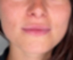 The same lips after a subtle lip filler treatment using hyaluronic acid. The result shows enhanced volume, a defined Cupid's bow, and deep hydration while maintaining natural texture.