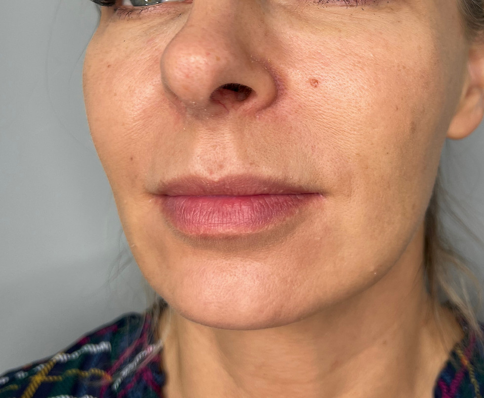 Before image showing lips before clinically assessed natural lip filler treatment at odNOVA Aesthetics in Brighton, photographed from an oblique facial view.