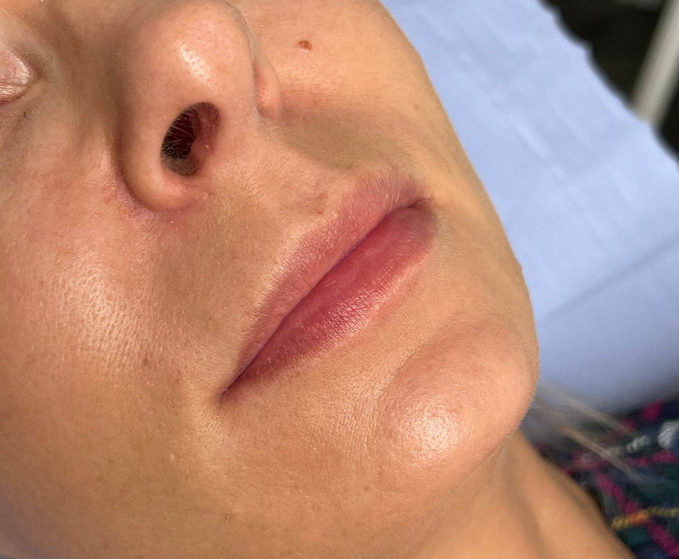 Before image showing lips before clinically assessed lip filler treatment at odNOVA Aesthetics in Brighton.
