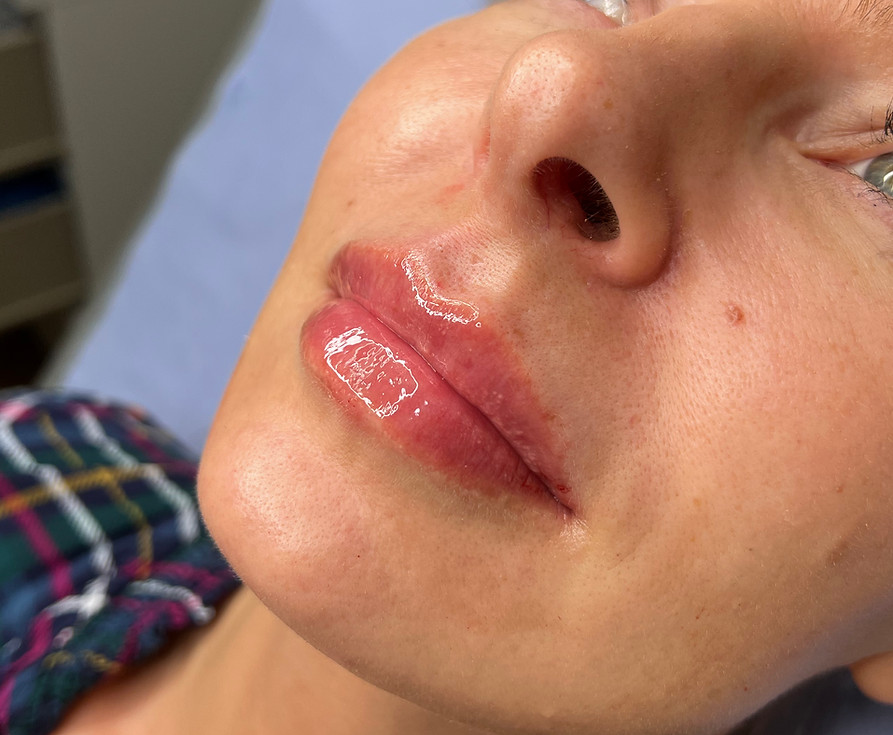 After image showing natural-looking lip filler treatment at odNOVA Aesthetics in Brighton, with subtle lip shape and hydration improvement.