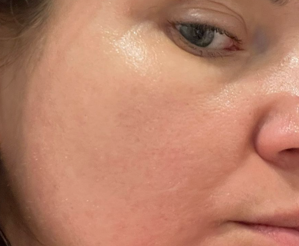 close-up of the same skin area after a medical-grade TCA peel. The skin appears calm, smooth, and refined with a significant reduction in redness and pore visibility.