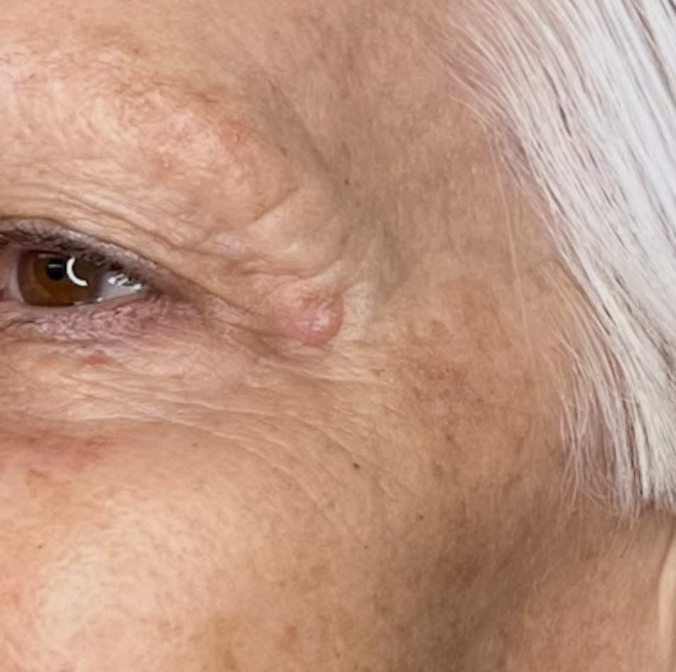 The same temple area after a TCA chemical peel, showing near-complete removal of the dark pigmentation and a much clearer, even skin tone at odNOVA Aesthetics.