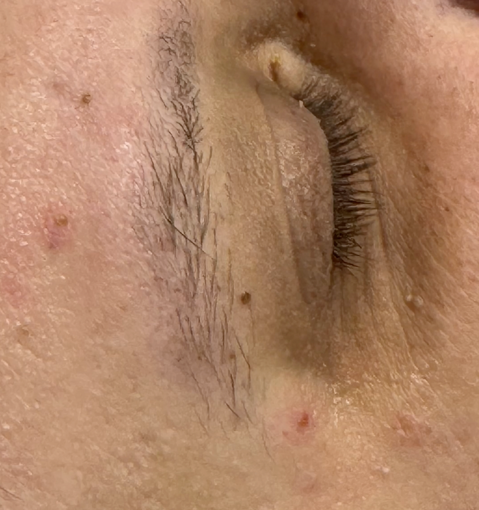 Skin near the eyebrow 5 days after clinically assessed benign skin lesion removal at odNOVA Aesthetics in Brighton, showing healing in progress.