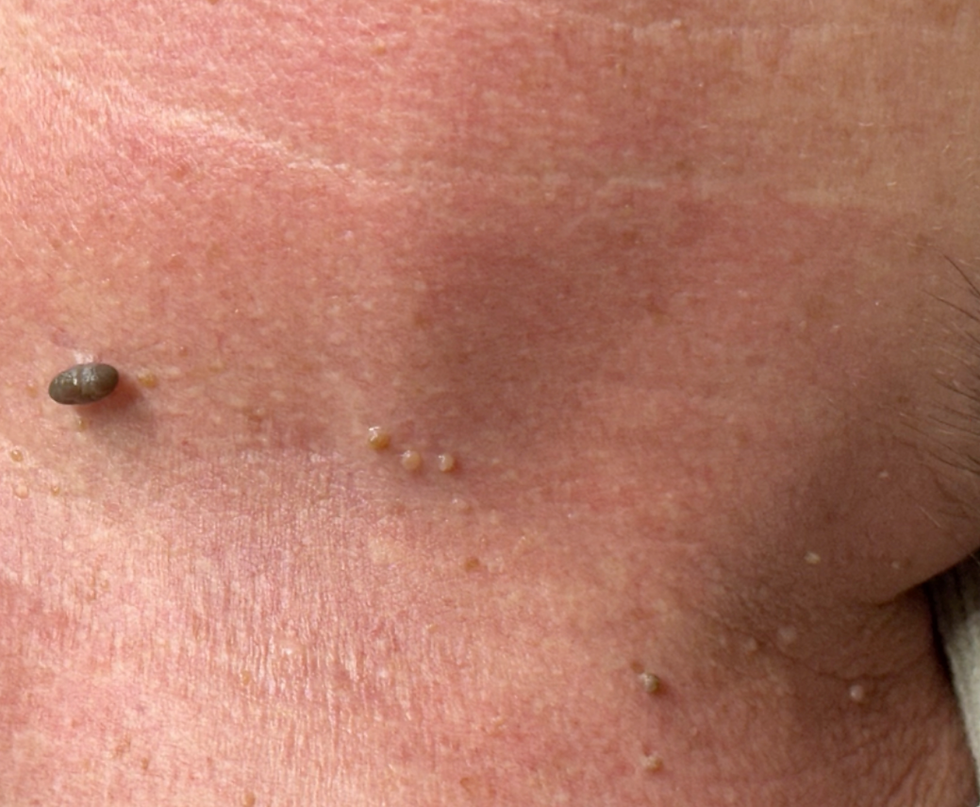 Multiple benign skin tags on the neck before clinical assessment and aesthetic removal at odNOVA Aesthetics in Brighton.