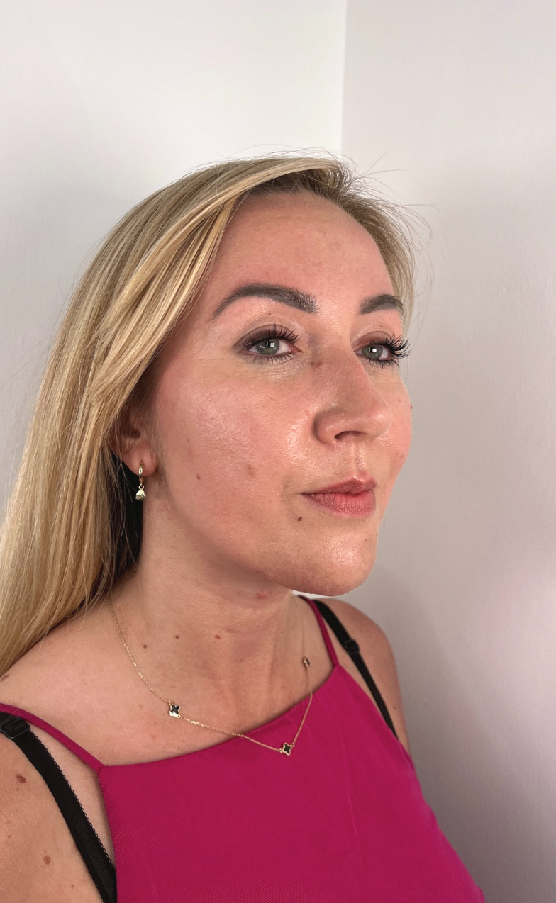 view after chin augmentation and jawline sculpting with dermal fillers at odNOVA Aesthetics in Brighton. The profile shows enhanced definition, a sharper jawline, and a balanced facial silhouette.
