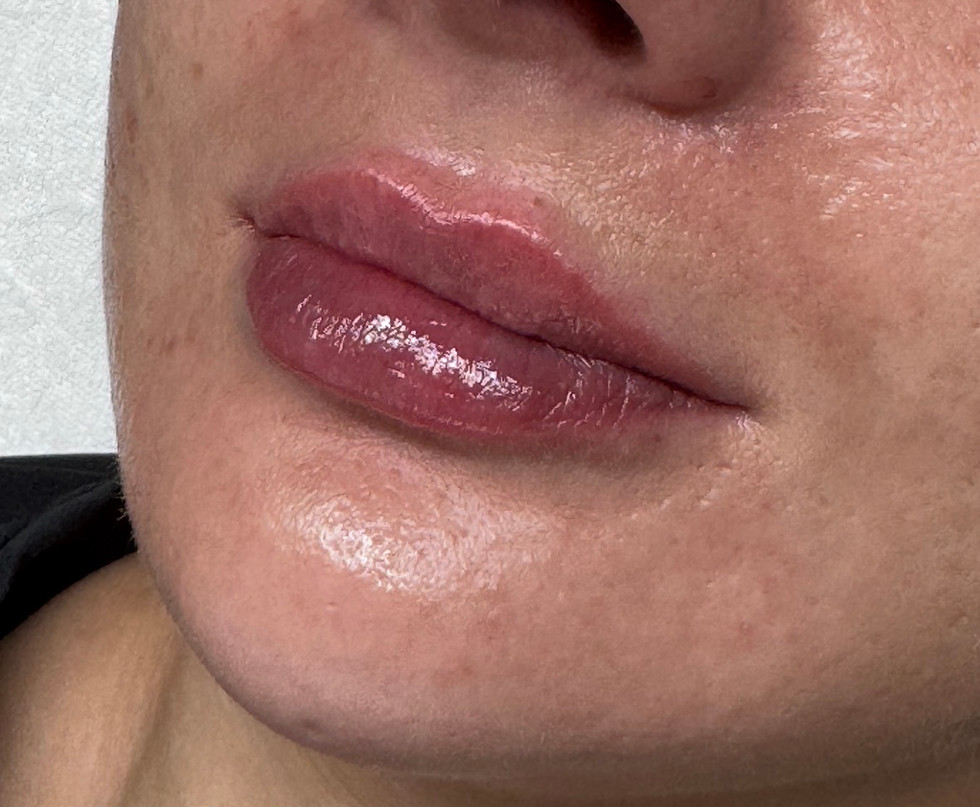 The same patient after dissolving old filler with hyaluronidase and receiving a precision refill. The results show a balanced, natural lip shape and restored facial harmony at odNOVA Aesthetics.