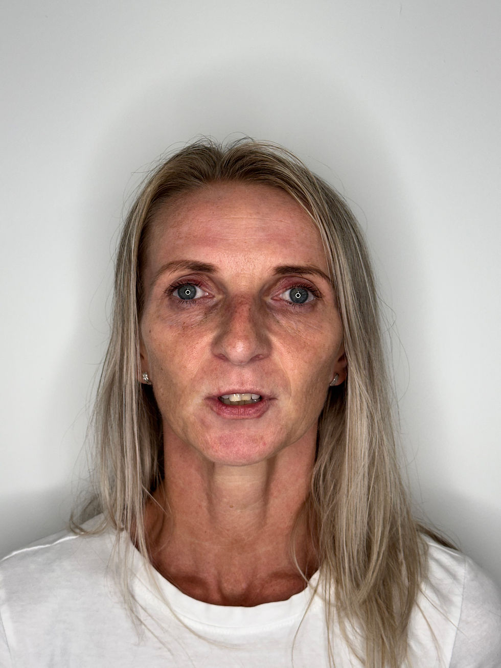 Frontal portrait of a patient before full face rejuvenation with dermal fillers at odNOVA Aesthetics in Brighton, showing areas of volume loss and uneven skin tone prior to clinical treatment.