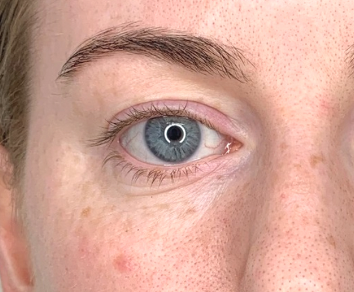 The same eye area after a Botox treatment to the lower eyelid, showing a smoother, flatter appearance with significantly reduced bagginess for a refreshed look at odNOVA Aesthetics.