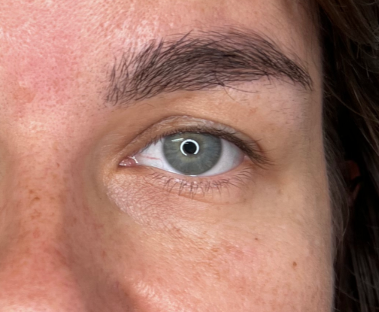 The same eye area after a targeted Botox treatment to relax the lower eyelid muscle. The prominent "roll" is flattened, resulting in a smoother, more open eye appearance at odNOVA Aesthetics.