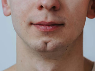 The secret behind Chin Dimples: Understanding and Treating Cleft