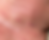 Neck skin shortly after benign skin tag removal at odNOVA Aesthetics in Brighton, showing expected early redness after treatment.