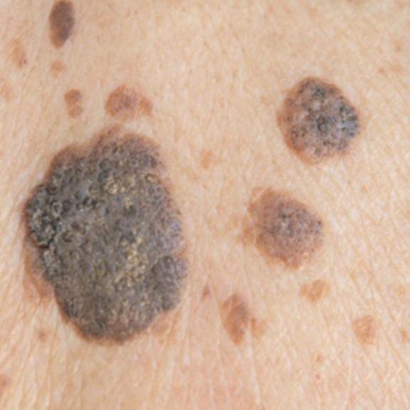 Close-up of multiple seborrhoeic keratoses with a characteristic 'stuck-on' and scaly appearance before clinical assessment at odNOVA Aesthetics in Brighton & Hove. These common benign lesions are examined via dermoscopy prior to aesthetic removal to ensure suitability for treatment.