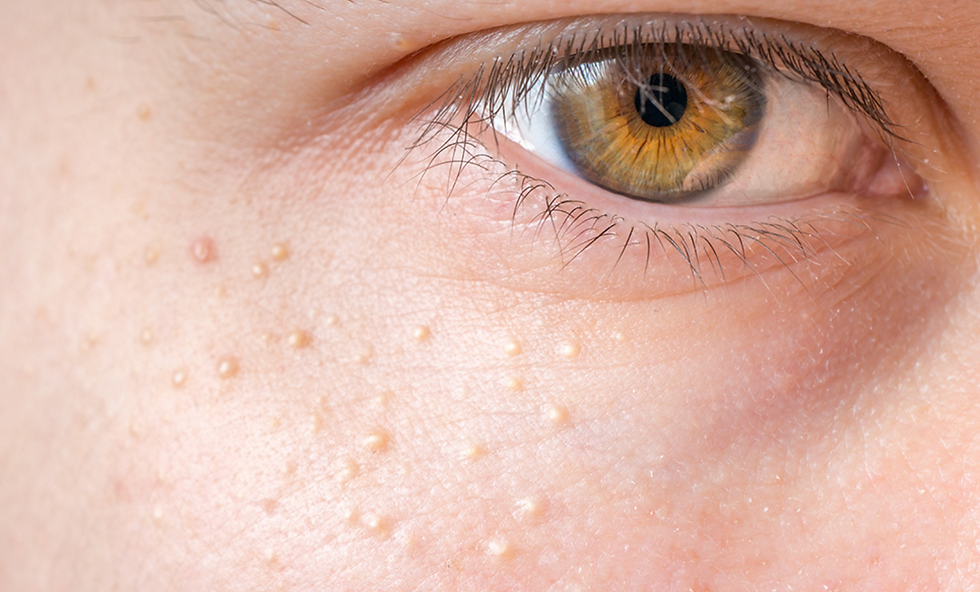 Close-up of multiple small, white milia cysts in the periorbital (under-eye) area before clinical assessment and professional extraction at odNOVA Aesthetics in Brighton.