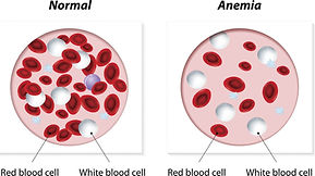 Do you feel Anemic? | Osteopathy Health Care