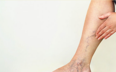 Varicose Veins Treatment in Ayurveda