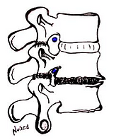 Espondiloartrosis lumbar