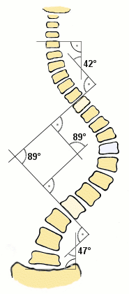 Ángulos Cobb Escoliosis