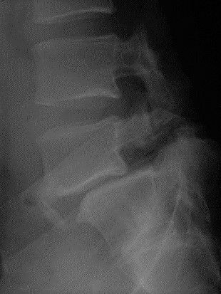 Desplazamiento de una vértebra sobre otra visualizada en radiografía lateral lumbar