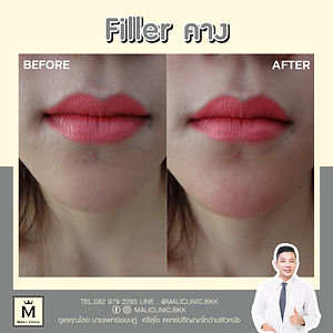 Chin Fillering 1.jpg