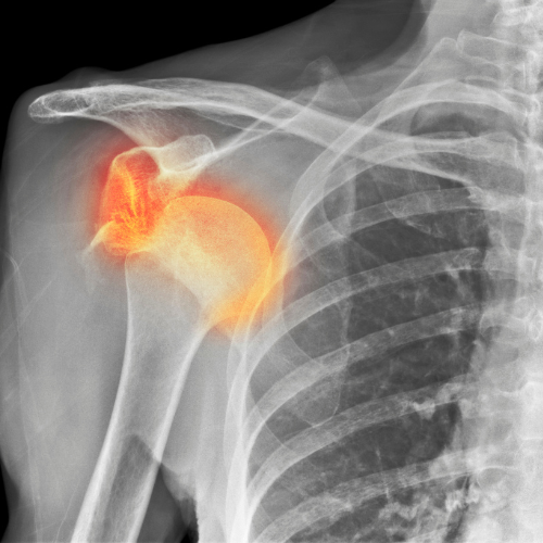 X-ray of left shoulder showing dislocated joint, with the humeral head highlighted in orange beside the ribs.