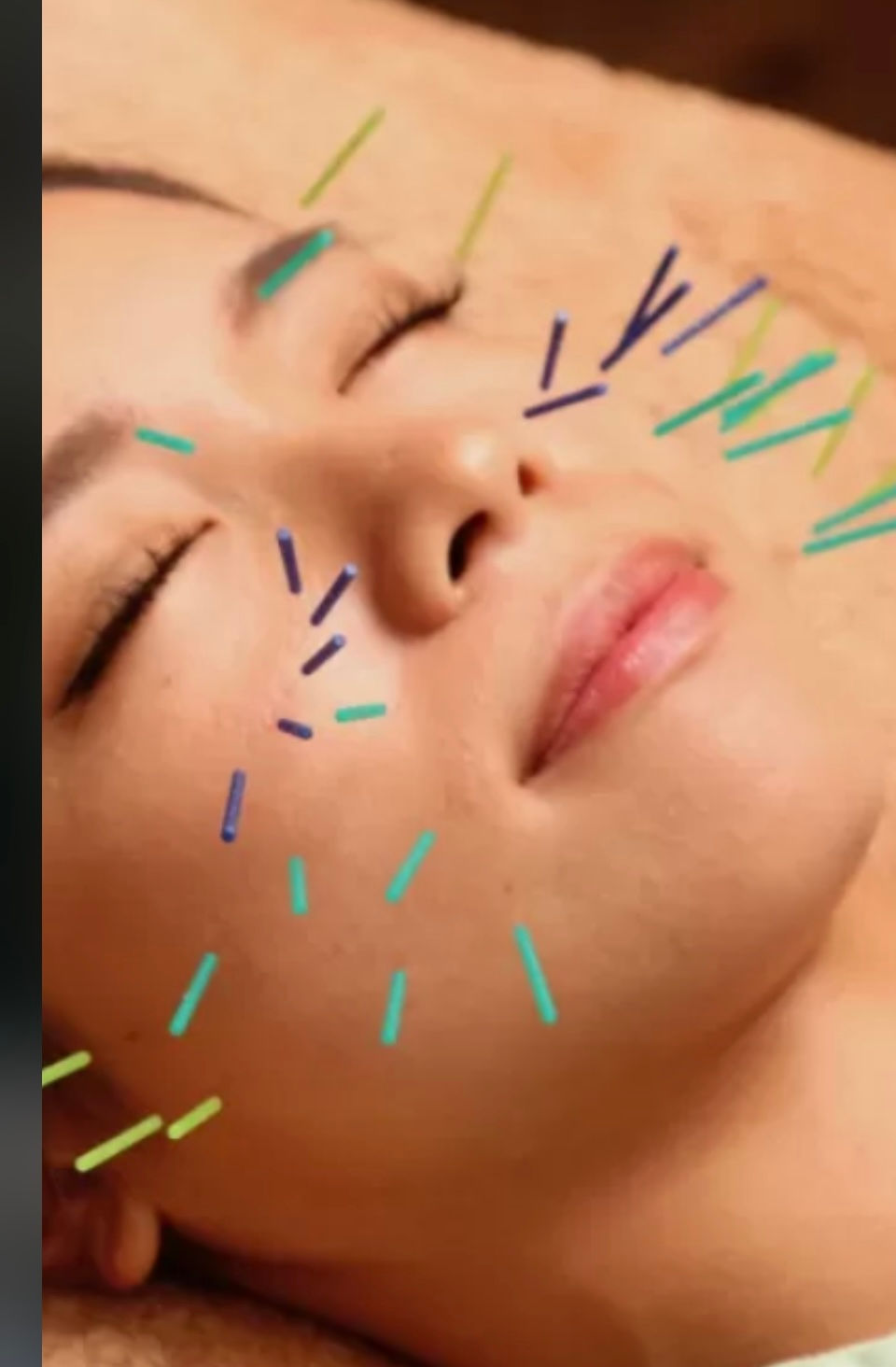 11月21日(金)美容鍼は当院にお任せ下さい✨