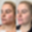Clear+and+Brilliant+Laser+Facial+(2).png