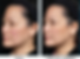 Clear+and+Brilliant+Laser+Facial+(6).png