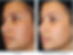 Clear+and+Brilliant+Laser+Facial+(3).png