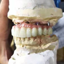Screw retained composite bridge19.jpeg