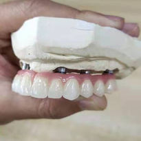 Screw retained composite bridge8.jpeg