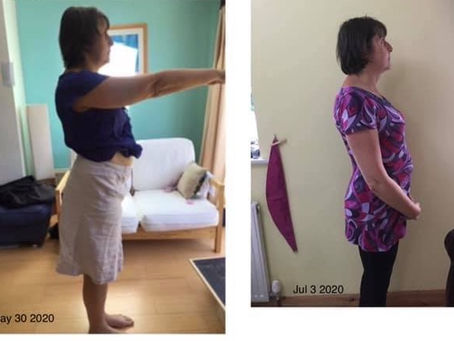 Ten years postnatal with diastasis 