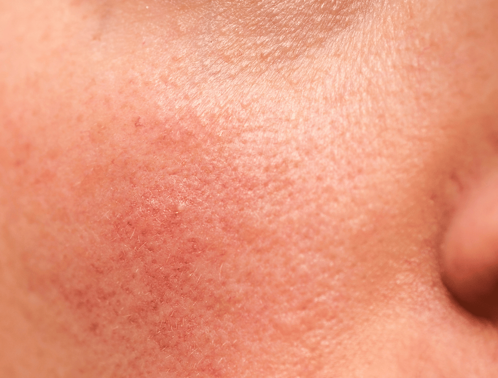 Why does uneven skin tone happen?