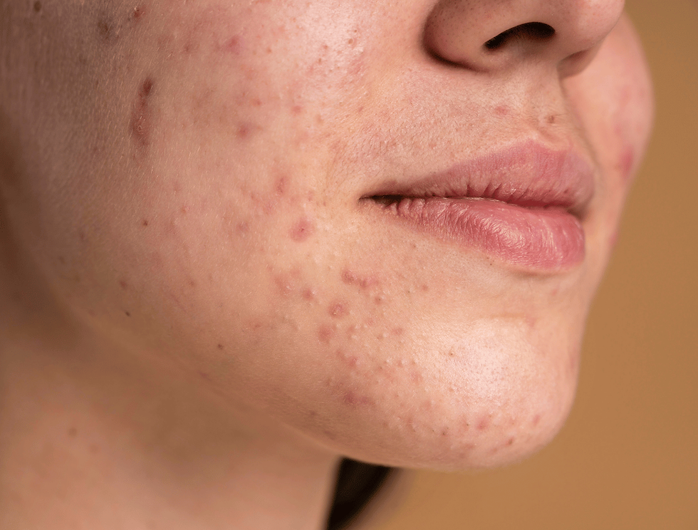Why does acne return in the same spot?