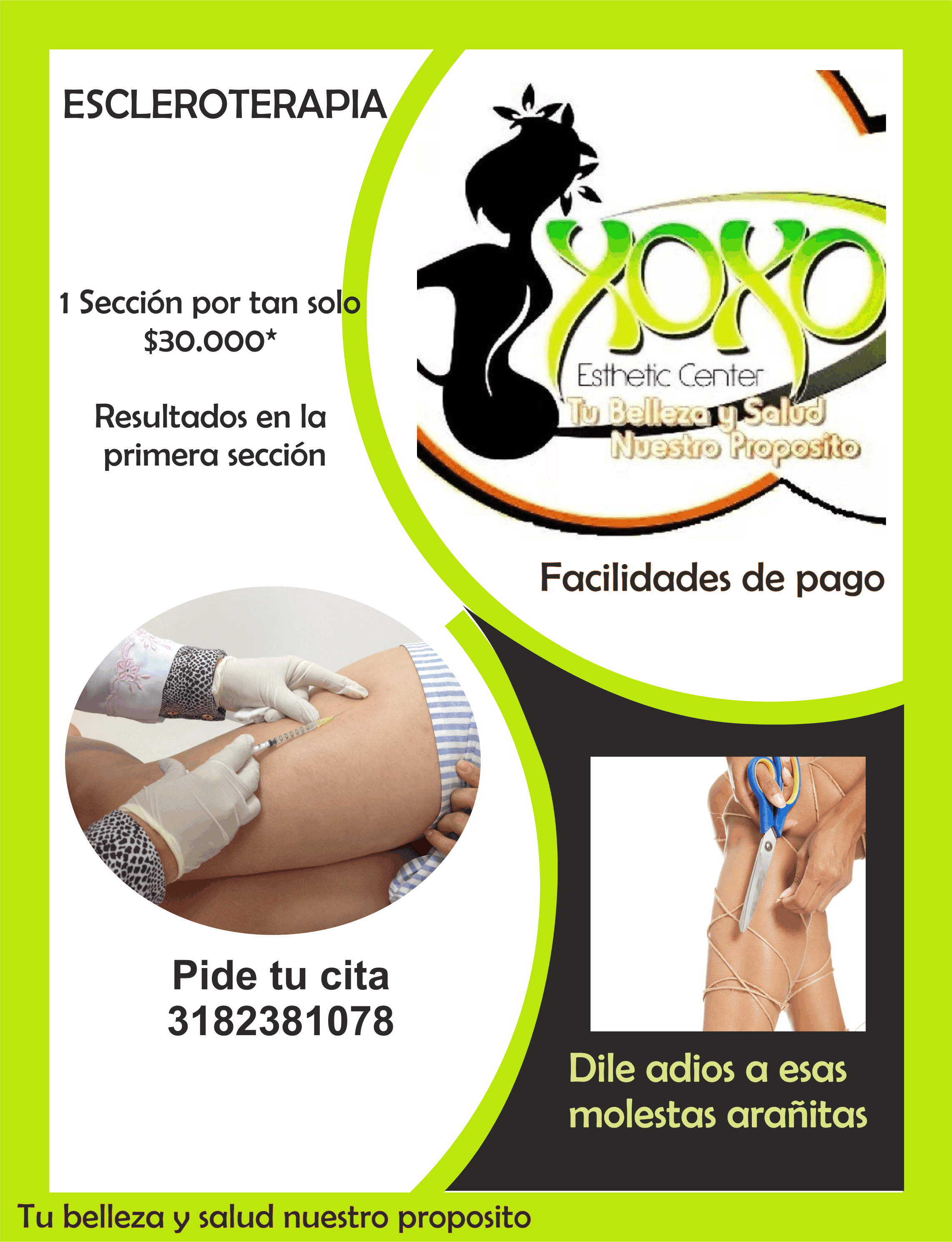 Escleroterapia