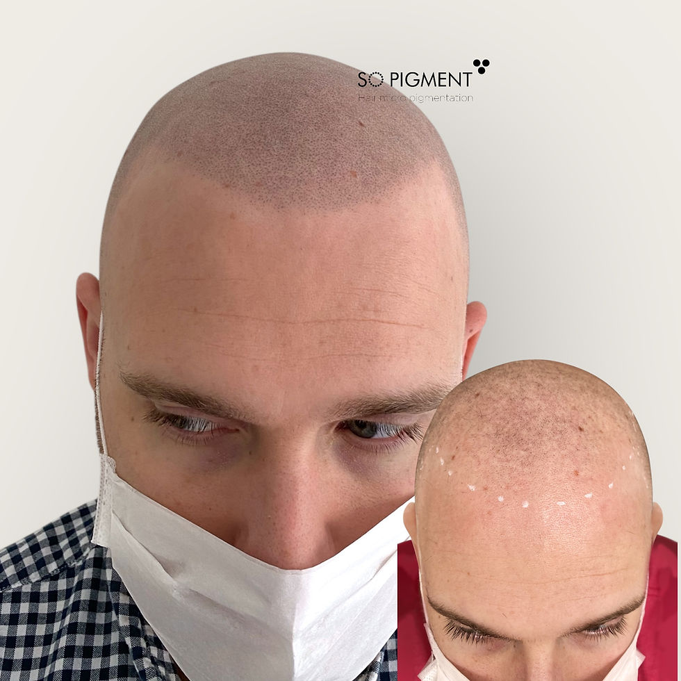tatouage-cheveux-homme-avant-apres
