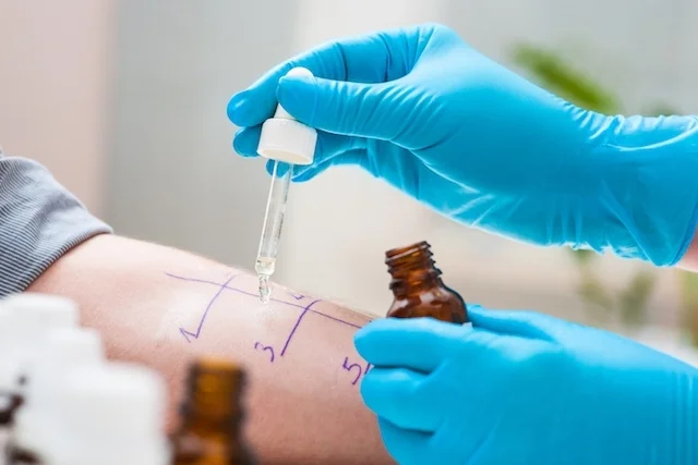Prick test exame.webp