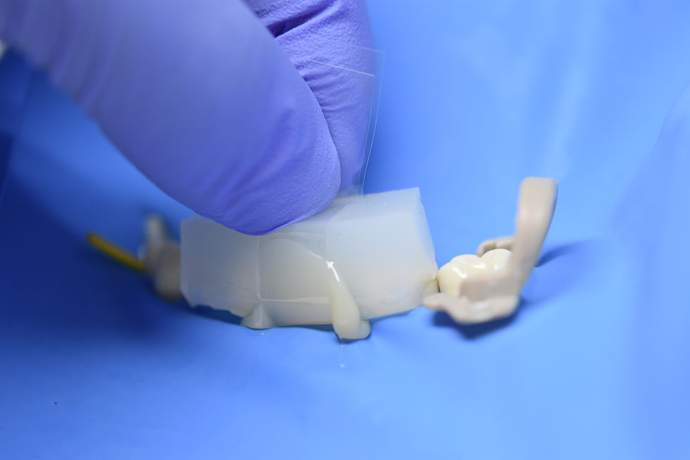 Retos clínicos de los puentes directos reforzados con fibras