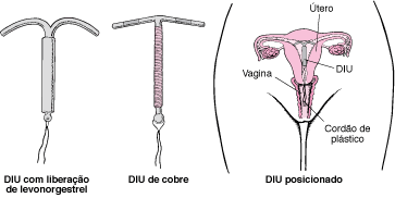 GYN_IUDs_pt.gif