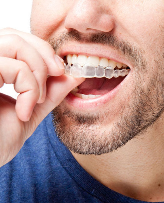 Get Best Alternative For Dental Braces by Invisalign