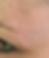 Scar after 12 treatments - no scar visible anymore