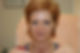 Facelift after treatment