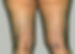 varicose veins before